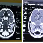 Difference between a CT scan and an MRI